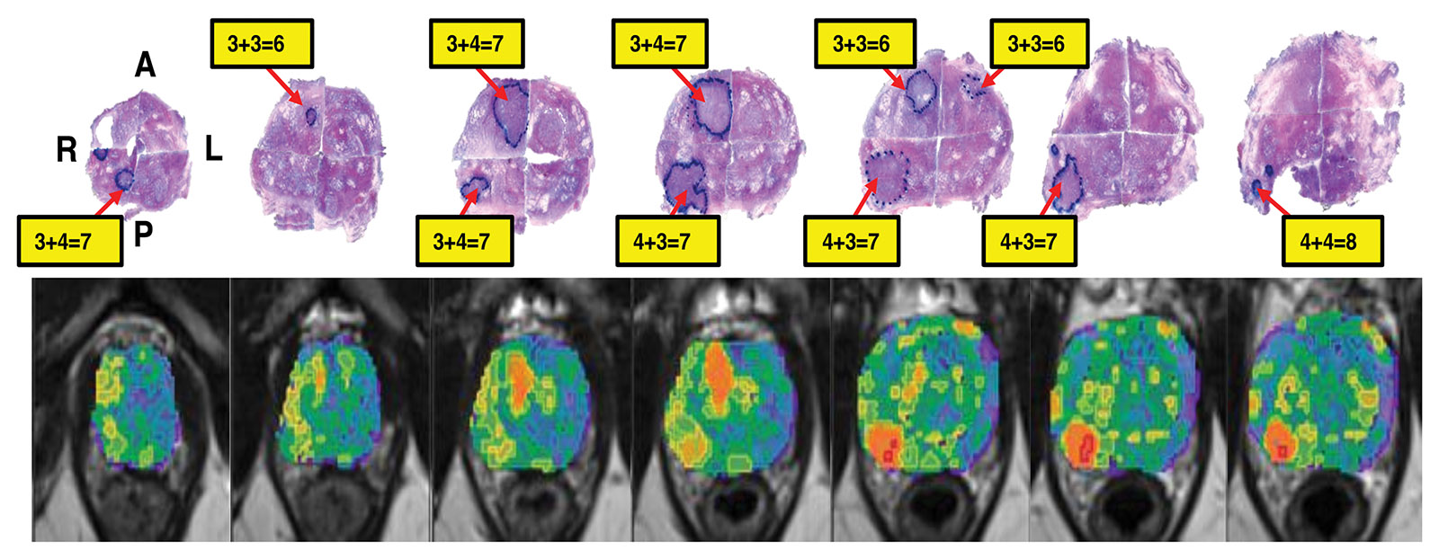 Correlation of habitat risk score in MRI images (bottom row) with the radical prostatectomy surgical specimens histological images (top row) in a man with prostate cancer.